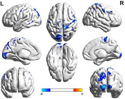 Disrupted Regional Cerebral Blood Flow in Children With Newly-Diagnosed Type 1 Diabetes Mellitus: An Arterial Spin Labeling Perfusion Magnetic Resonance Imaging Study